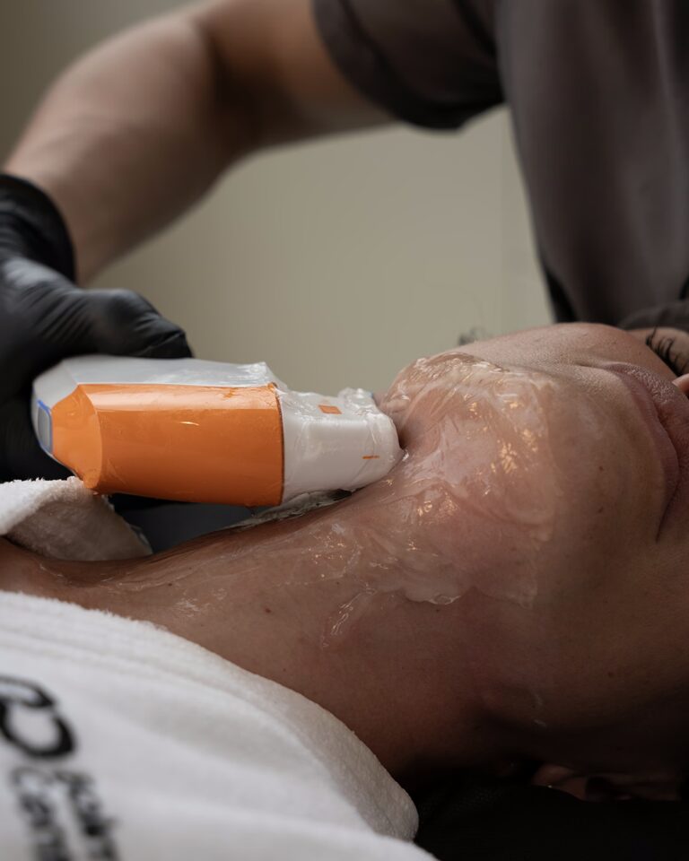 Reafirmación profunda y estimulación de colageno en el rostro Ultherapy, ultraformer - Balmori Center