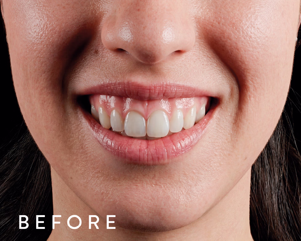 Balmori Center - SONRISA GINGIVAL