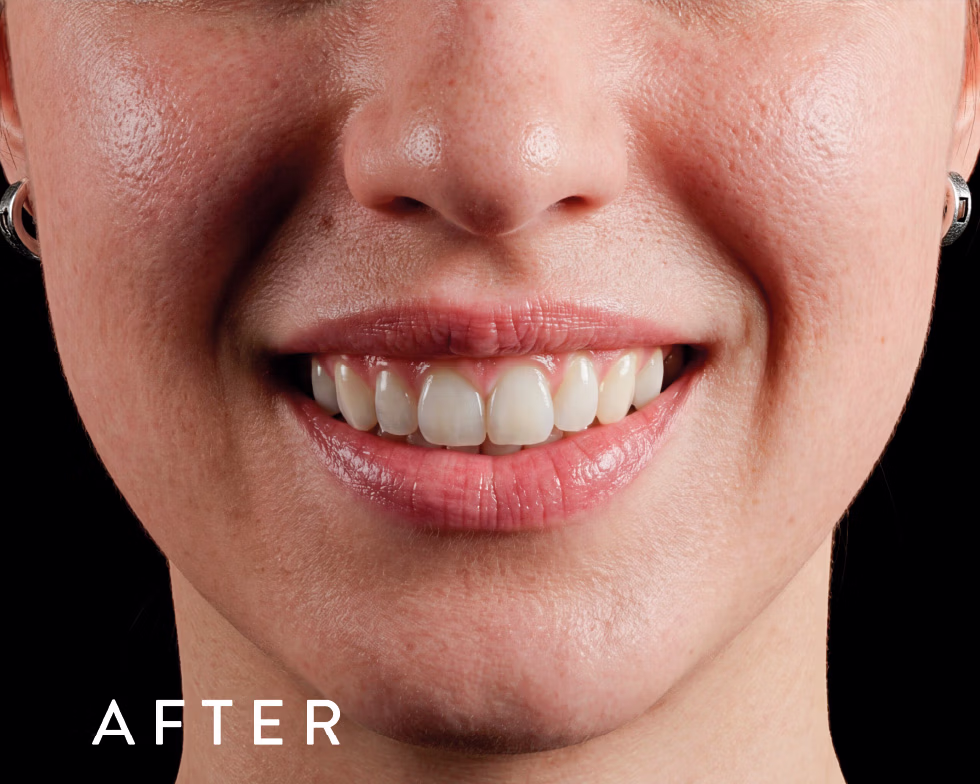 Balmori Center - SONRISA GINGIVAL