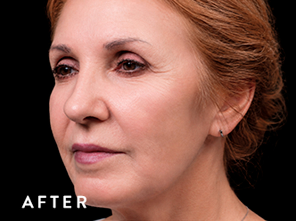 Balmori Center - EXION FRACIONADO -RADIOFRECUENCIA FRACCIONADA CON MICRONEEDLING E INTELIGENCIA ARTIFICIAL