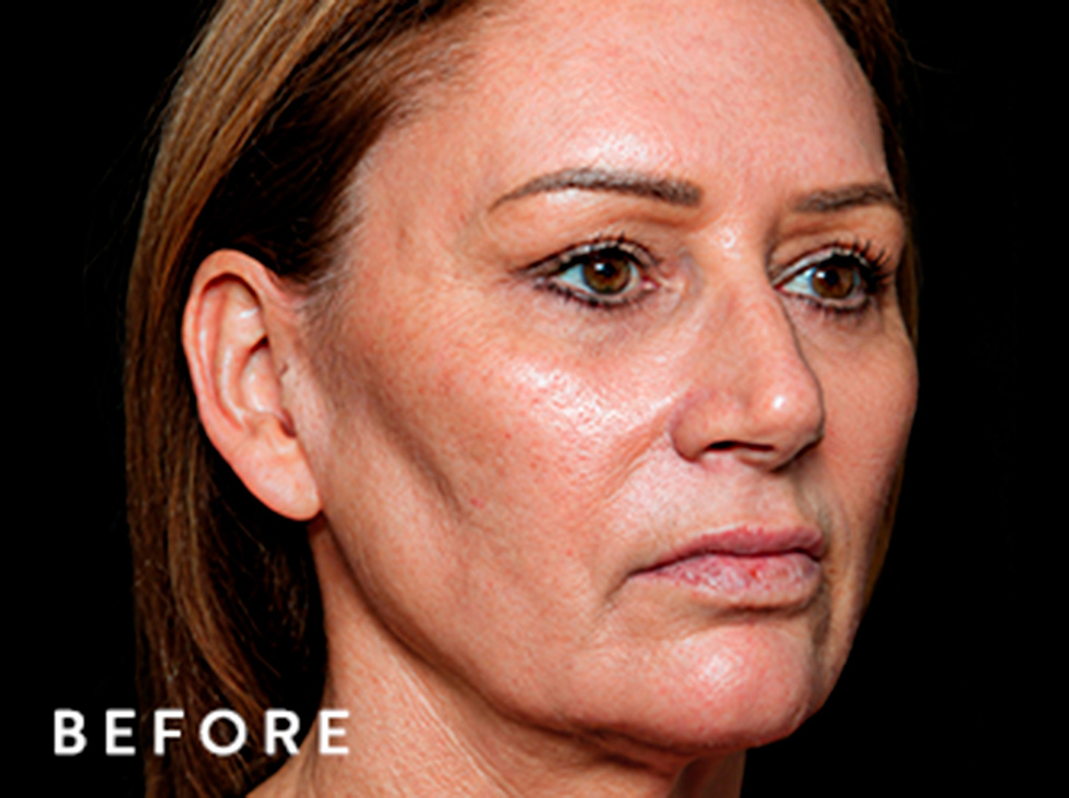 Balmori Center - EXION FRACIONADO -RADIOFRECUENCIA FRACCIONADA CON MICRONEEDLING E INTELIGENCIA ARTIFICIAL