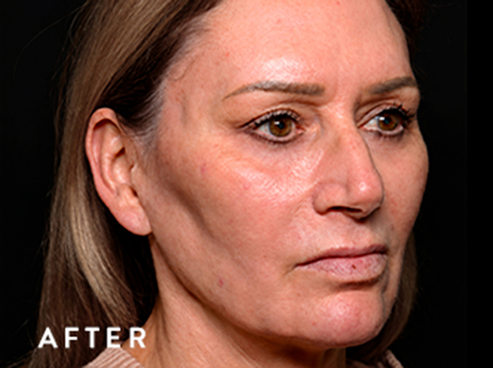 Balmori Center - EXION FRACIONADO -RADIOFRECUENCIA FRACCIONADA CON MICRONEEDLING E INTELIGENCIA ARTIFICIAL