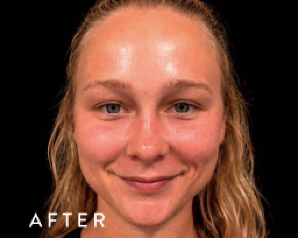 Balmori Center - LIMPIEZA PROFUNDA - HYDRAFACIALES
