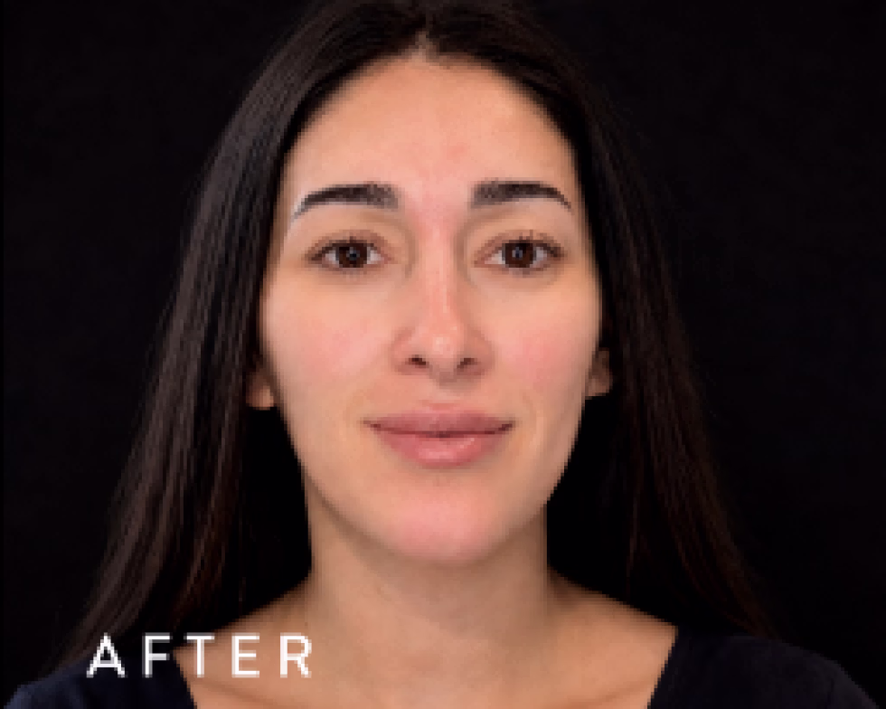 Balmori Center - LIMPIEZA PROFUNDA - HYDRAFACIALES