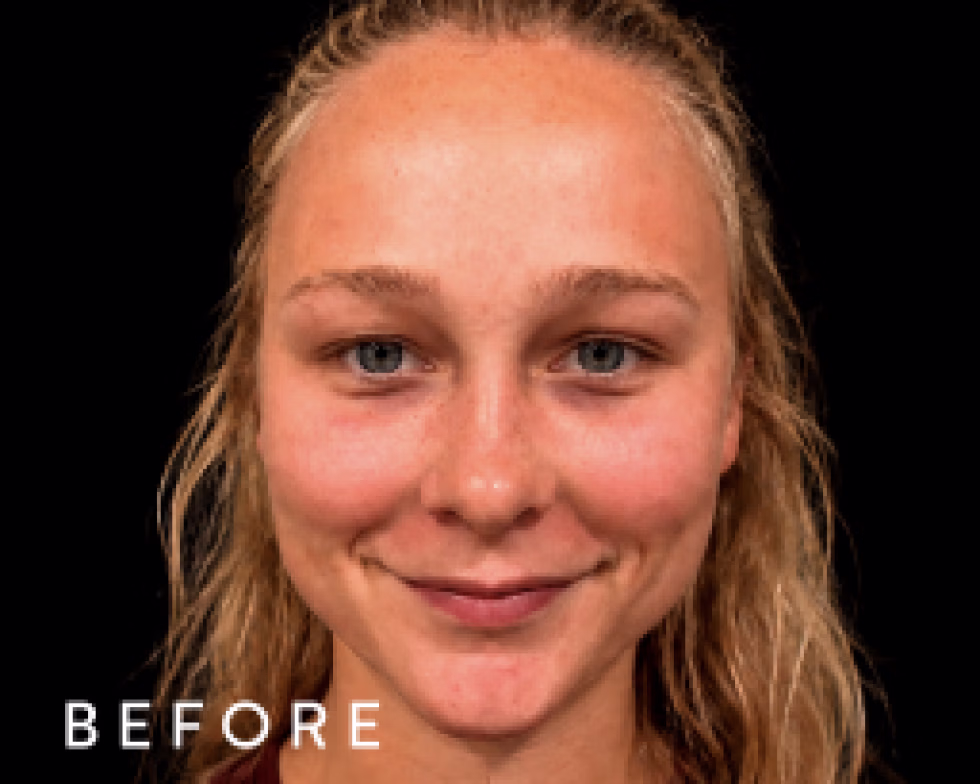 Balmori Center - LIMPIEZA PROFUNDA - HYDRAFACIALES