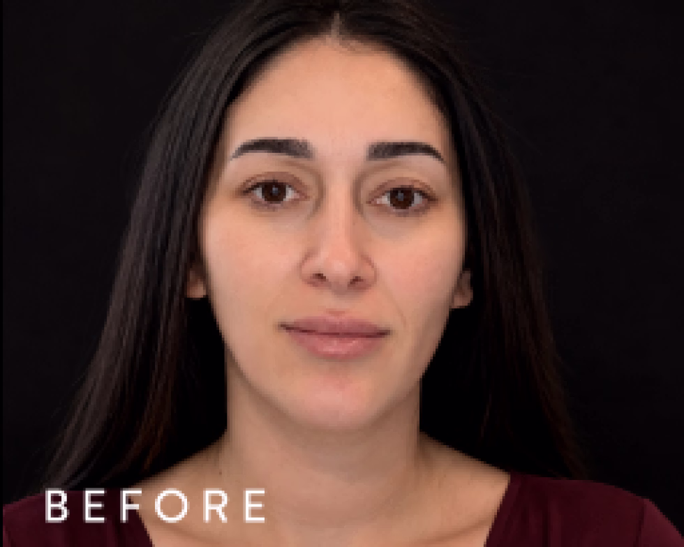 Balmori Center - LIMPIEZA PROFUNDA - HYDRAFACIALES