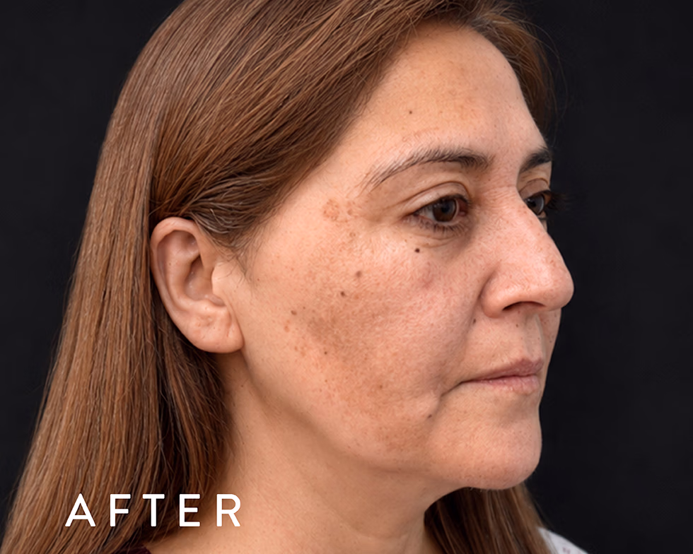Balmori Center - LÁSER CO2 FRACCIONADO