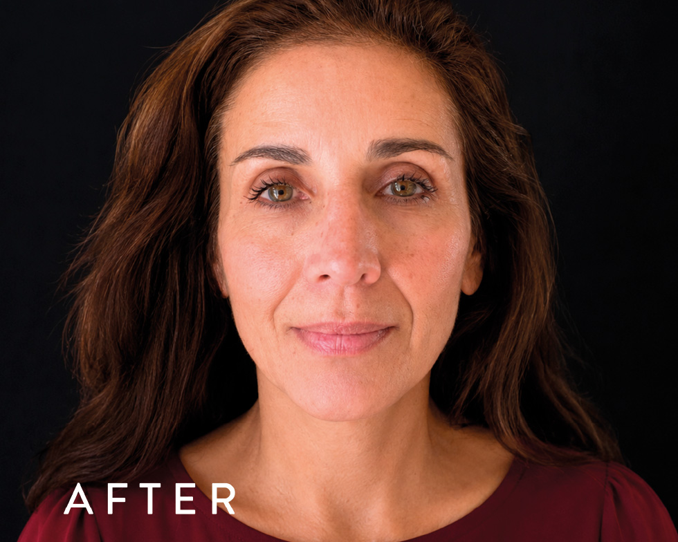 Balmori Center - REDUCIR CICATRICES - MICRONEEDLING