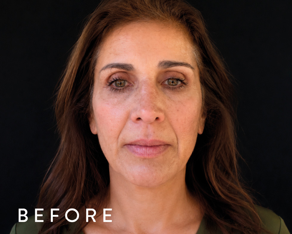 Balmori Center - REDUCIR CICATRICES - MICRONEEDLING