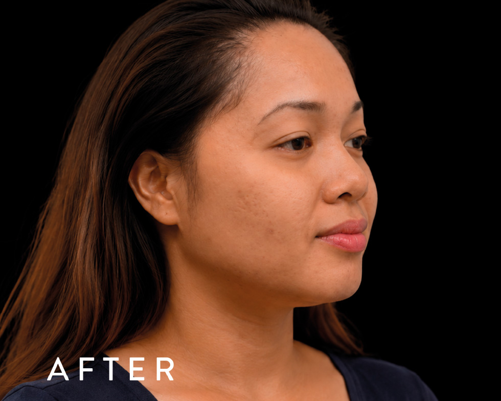 Balmori Center - REDUCIR CICATRICES - MICRONEEDLING