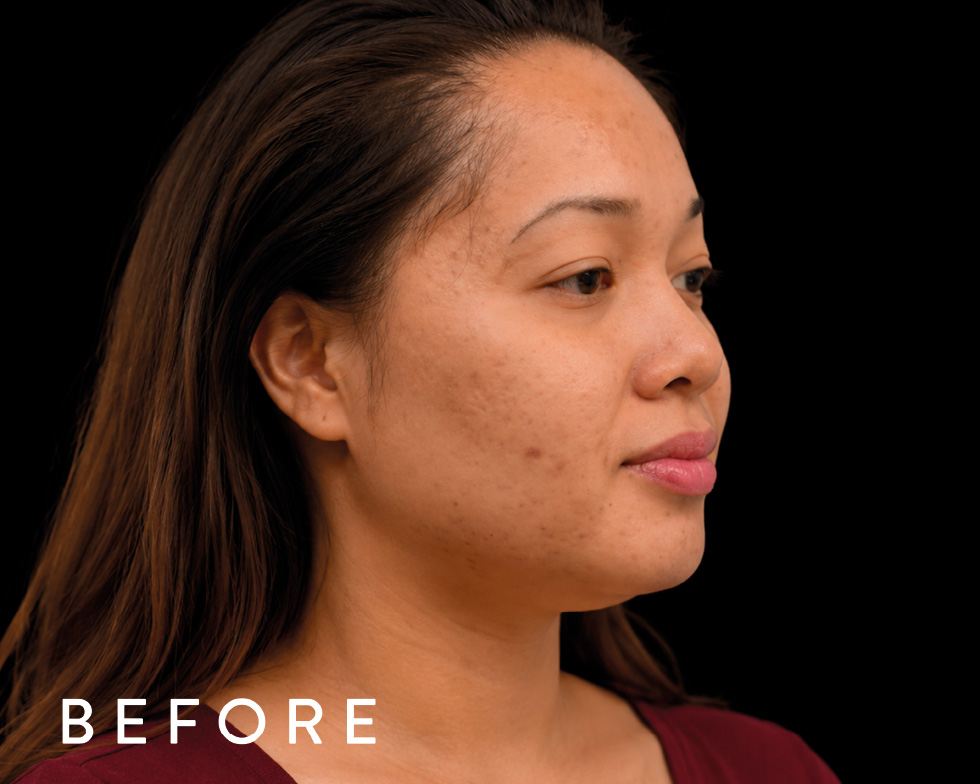 Balmori Center - REDUCIR CICATRICES - MICRONEEDLING