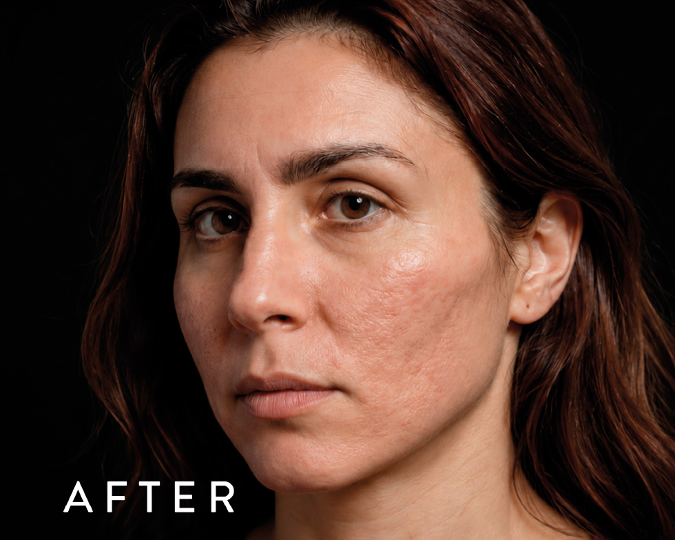 Close-up portrait of a woman showing skin after treatment, with the word AFTER in the corner.