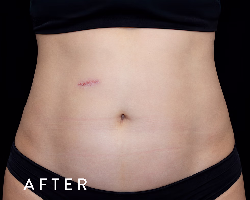 Balmori Center - MARCAR ABDOMEN, ENZIMAS LIPOLÍTICAS