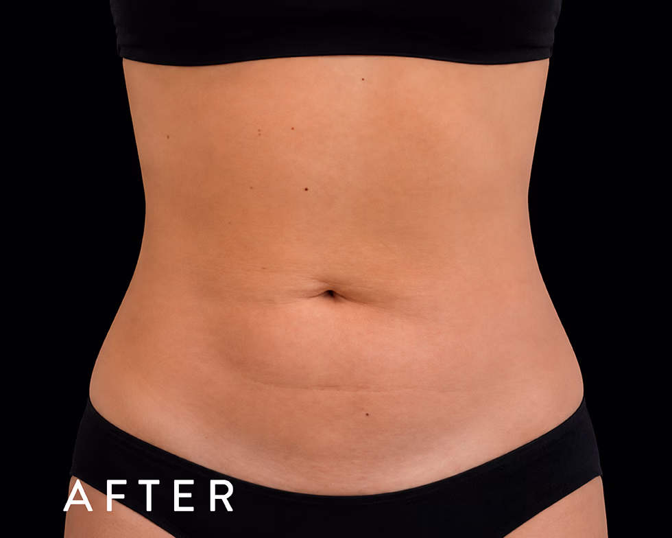 Balmori Center - MARCAR ABDOMEN, ENZIMAS LIPOLÍTICAS