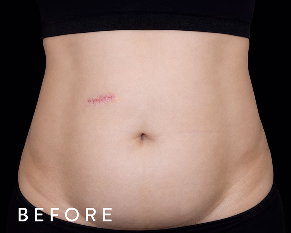 Balmori Center - MARCAR ABDOMEN, ENZIMAS LIPOLÍTICAS