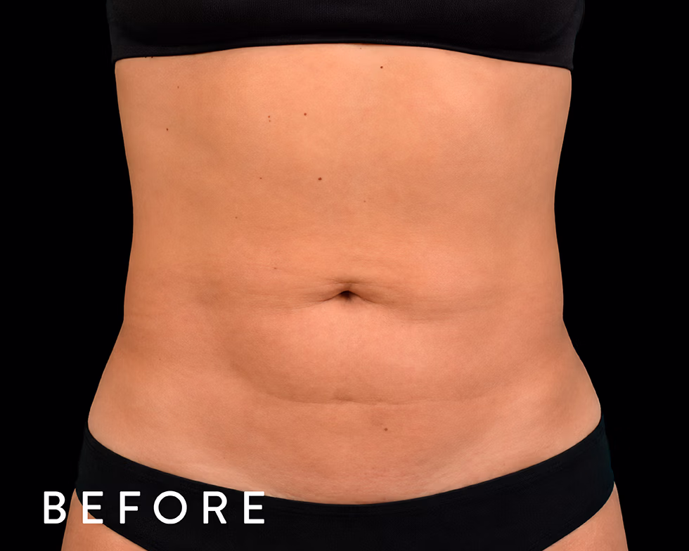 Balmori Center - MARCAR ABDOMEN, ENZIMAS LIPOLÍTICAS