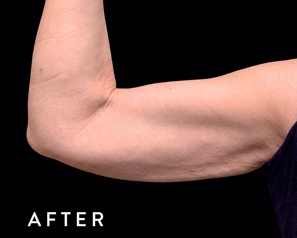 Balmori Center - Servicios - TONIFICAR BICEPS, TRICEPS Y GLÚTEOS - emsculpt CLÁSICO - HIFEM / Energía electromagnética focalizada de Alta Intensidad
