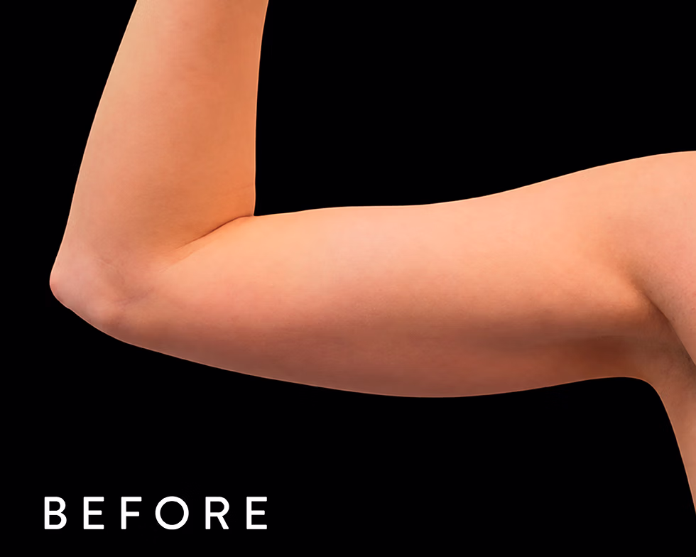 Balmori Center - Servicios - TONIFICAR BICEPS, TRICEPS Y GLÚTEOS - emsculpt CLÁSICO - HIFEM / Energía electromagnética focalizada de Alta Intensidad