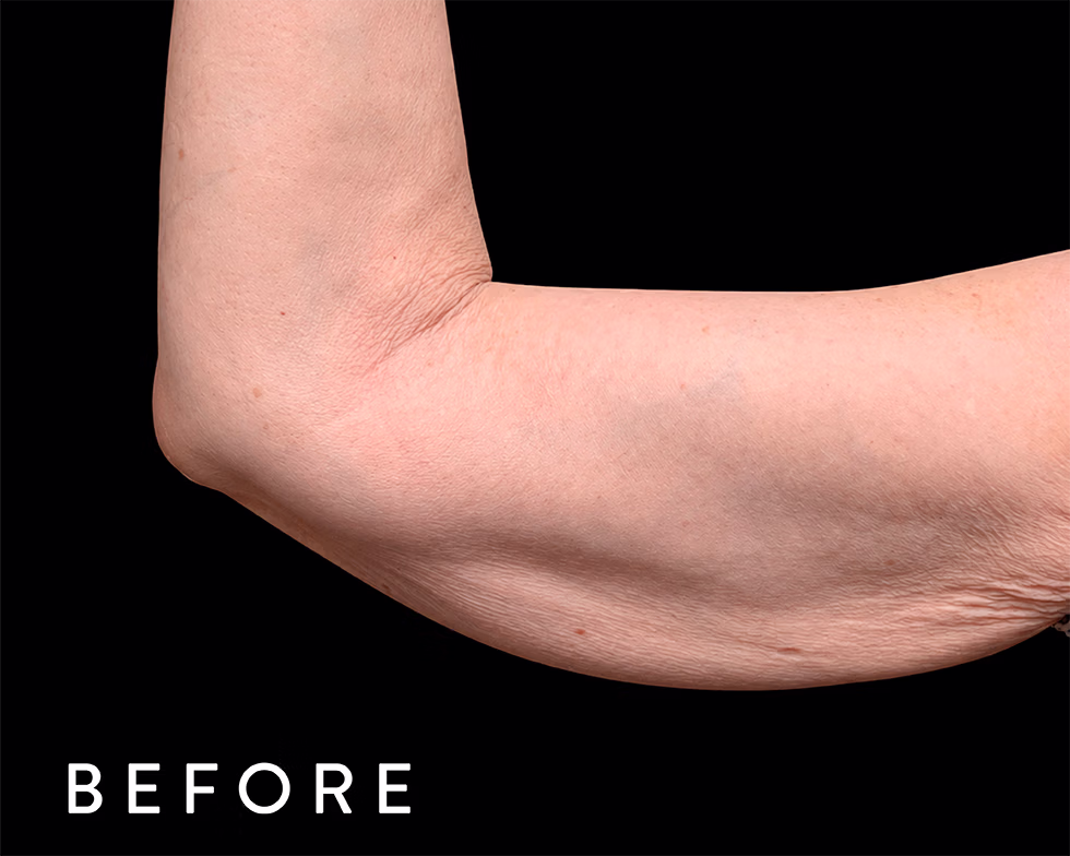 Balmori Center - Servicios - TONIFICAR BICEPS, TRICEPS Y GLÚTEOS - emsculpt CLÁSICO - HIFEM / Energía electromagnética focalizada de Alta Intensidad