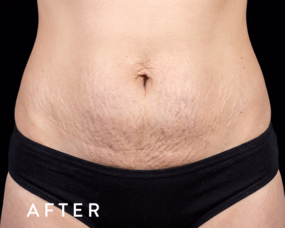 Balmori Center - REDUCIR ESTRÍAS Y CICATRICES - DERMAPEN - MICRONEEDLING