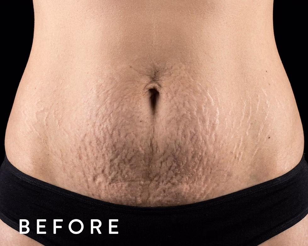 Balmori Center - REDUCIR ESTRÍAS Y CICATRICES - DERMAPEN - MICRONEEDLING