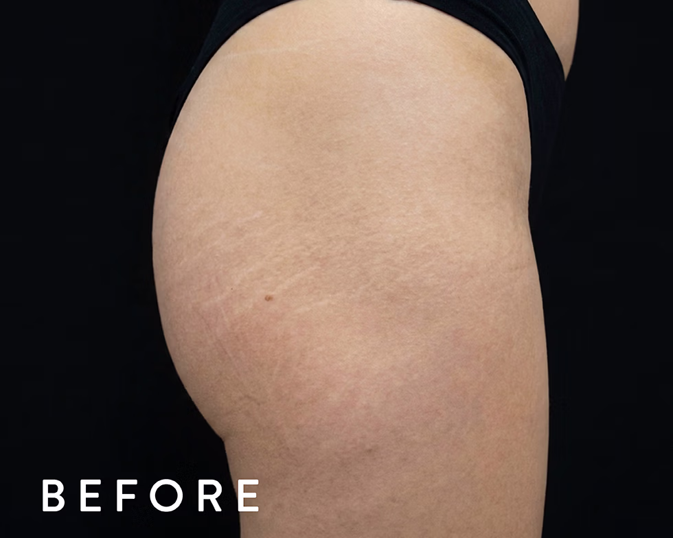 Balmori Center - REDUCIR ESTRÍAS Y CICATRICES - DERMAPEN - MICRONEEDLING