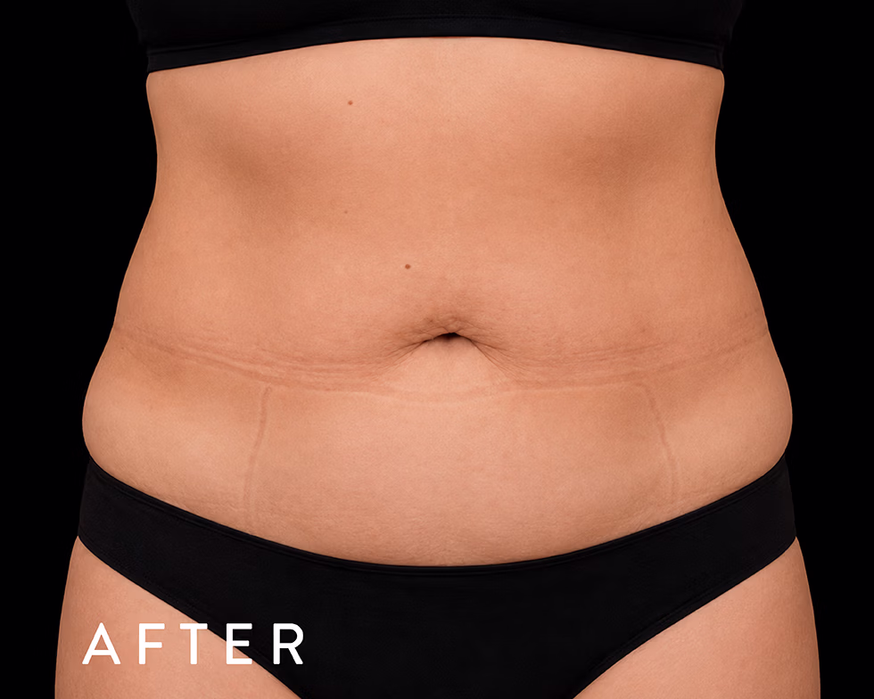 Balmori Center - REDUCIR CELULITIS Y FLACIDEZ BRAZOS, PIERNAS, GLÚTEOS Y ABDOMEN - EMTONE - Ondas de choque con radiofrecuencia