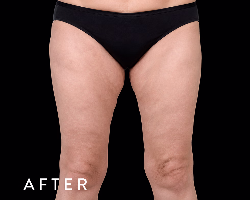 Balmori Center - REDUCIR CELULITIS Y FLACIDEZ BRAZOS, PIERNAS, GLÚTEOS Y ABDOMEN - EMTONE - Ondas de choque con radiofrecuencia