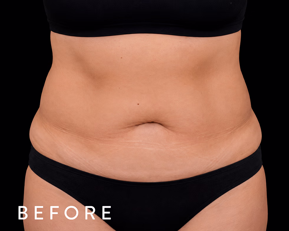 Before photo of a person's midsection in black underwear, showing loose abdomen and love handles with a 'BEFORE' label.