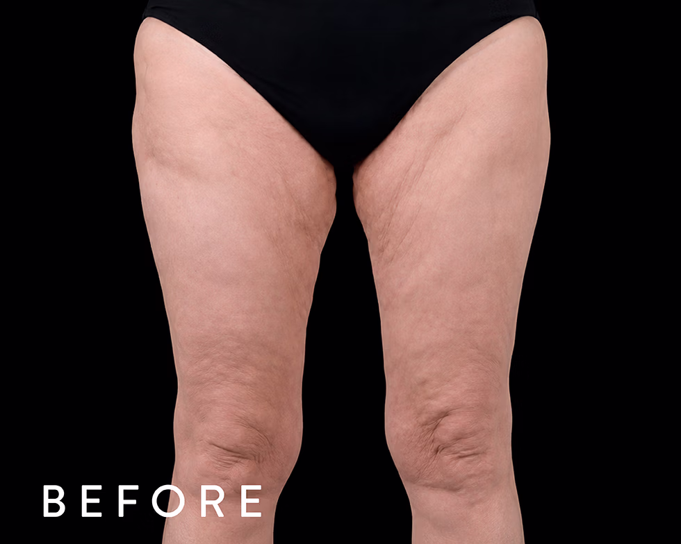 Balmori Center - REDUCIR CELULITIS Y FLACIDEZ BRAZOS, PIERNAS, GLÚTEOS Y ABDOMEN - EMTONE - Ondas de choque con radiofrecuencia