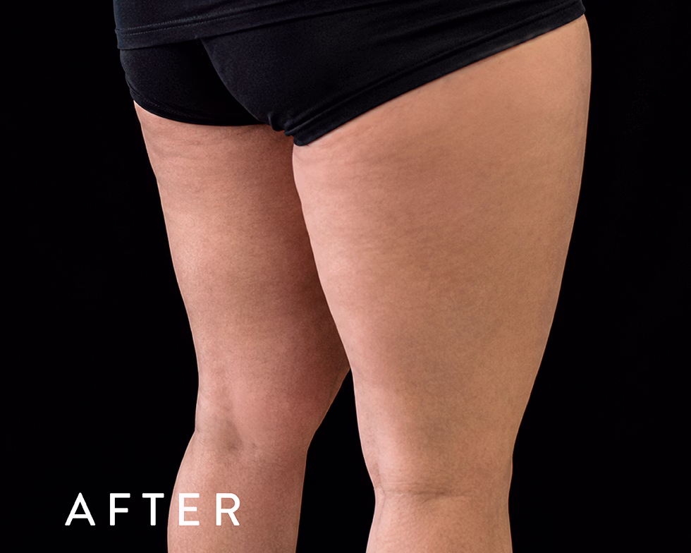 Balmori Center - REDUCIR CELULITIS Y FLACIDEZ BRAZOS, PIERNAS, GLÚTEOS Y ABDOMEN - Presoterapia