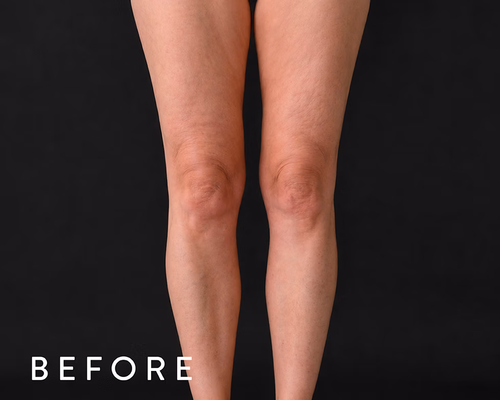 Front view of two legs from mid-thigh to feet against a dark background; knees visible, with the word BEFORE in the bottom-left corner.