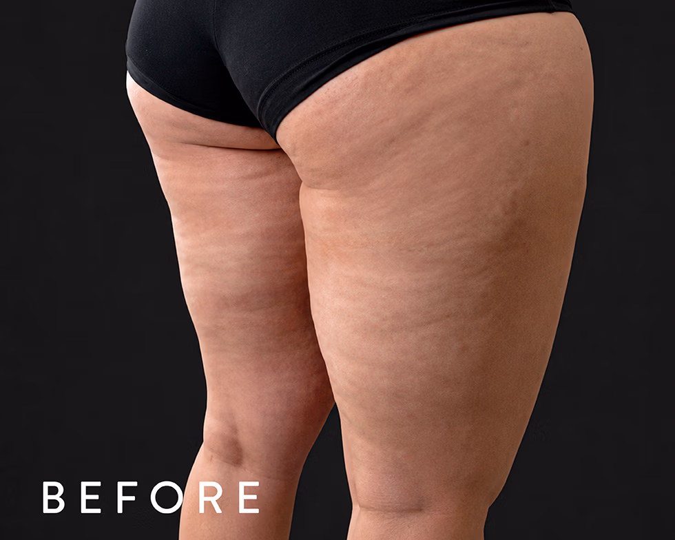Close-up of a woman's thighs and buttocks with cellulite against a dark background, with the word BEFORE in the bottom-left corner.