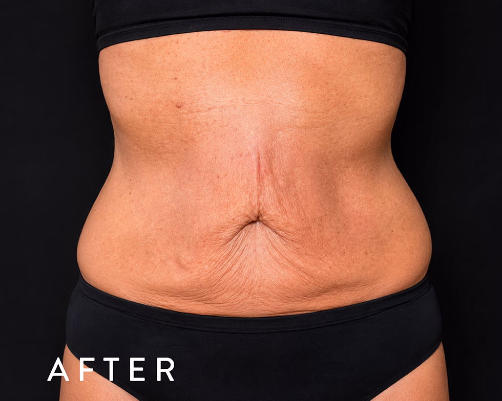 Balmori Center - REDUCIR CELULITIS Y FLACIDEZ BRAZOS, PIERNAS, GLÚTEOS Y ABDOMEN - EXION FRACCIONADO - Radiofrecuencia fraccionada con microagujas guiada por IA