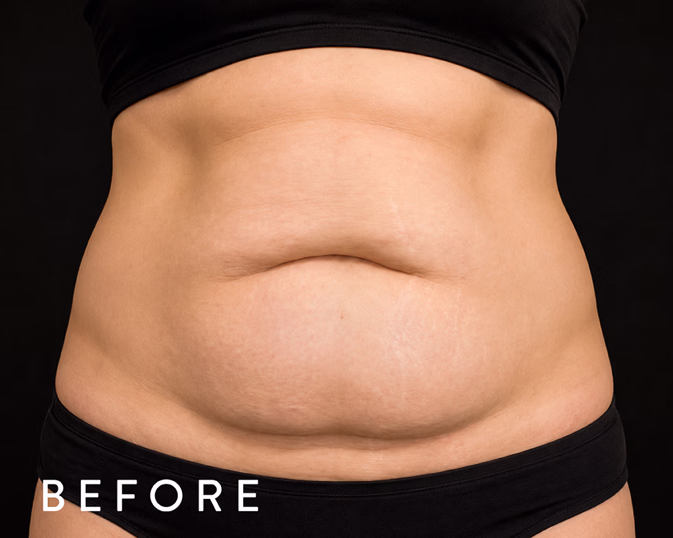 Balmori Center - REDUCIR CELULITIS Y FLACIDEZ BRAZOS, PIERNAS, GLÚTEOS Y ABDOMEN - EXION FRACCIONADO - Radiofrecuencia fraccionada con microagujas guiada por IA