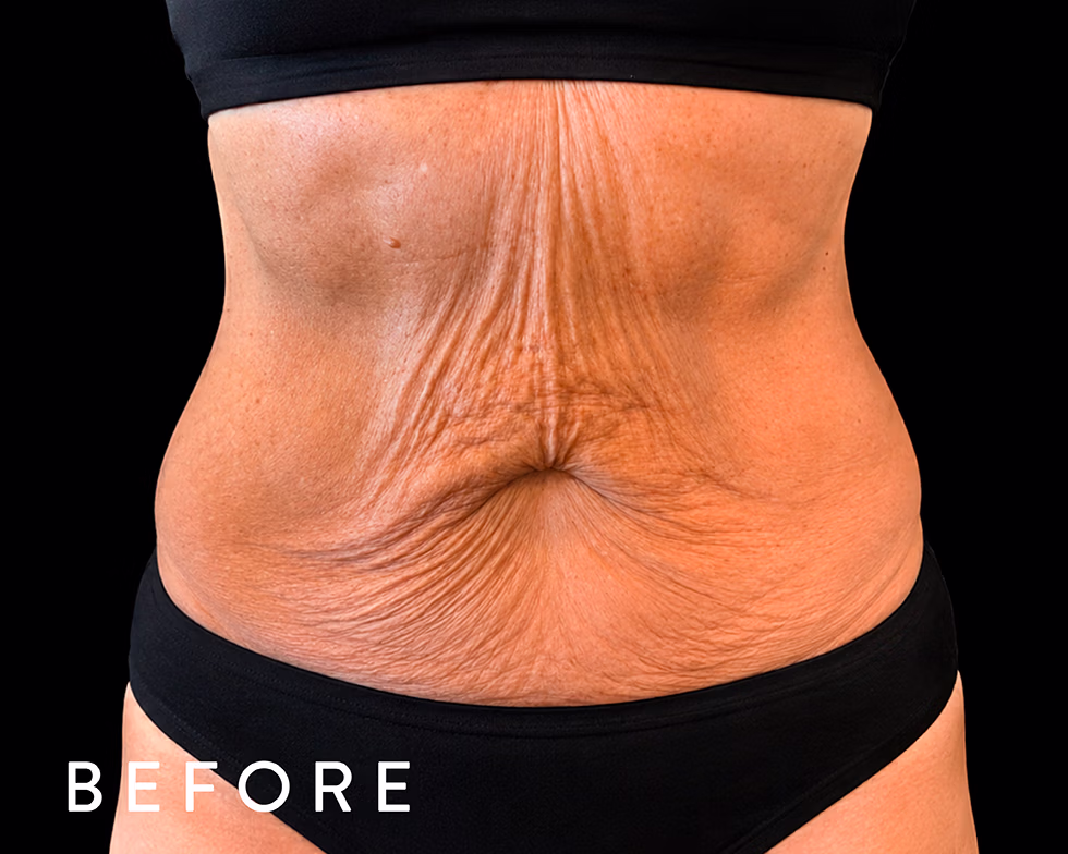 Balmori Center - REDUCIR CELULITIS Y FLACIDEZ BRAZOS, PIERNAS, GLÚTEOS Y ABDOMEN - EXION FRACCIONADO - Radiofrecuencia fraccionada con microagujas guiada por IA