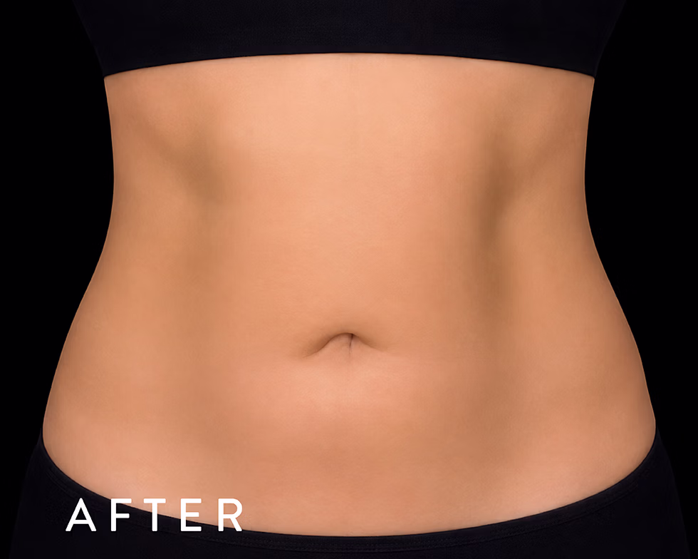 Close-up of a toned midsection in black underwear; the word 'AFTER' suggests a post-treatment result.
