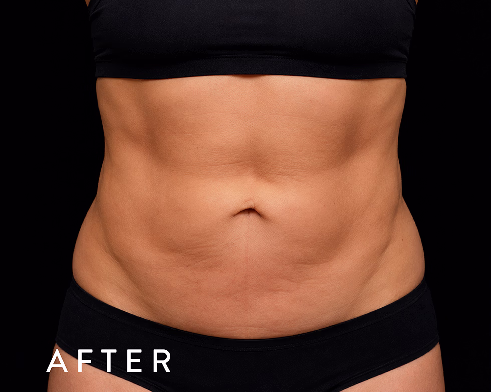 Toned abdomen with smooth skin after treatment, wearing black underwear against a dark background, 'AFTER' label in corner.