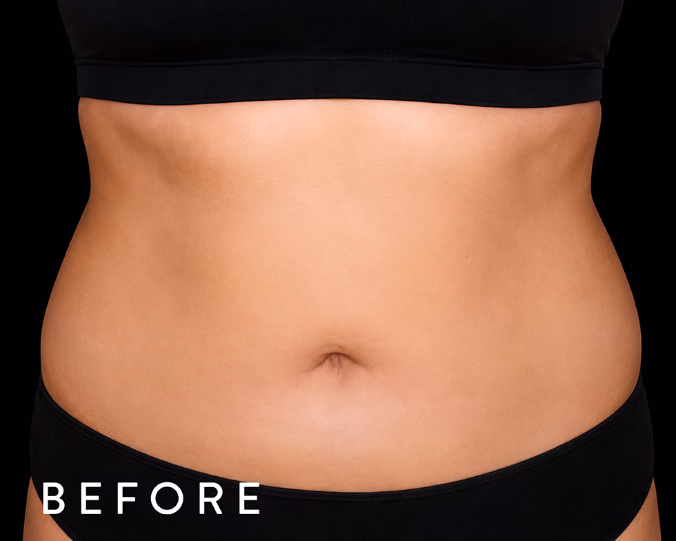 Balmori Center - REDUCIR CELULITIS Y FLACIDEZ BRAZOS, PIERNAS, GLÚTEOS Y ABDOMEN - ZIONIC - Radiofrecuencia con masaje rotacional