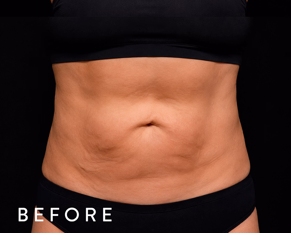 Balmori Center - REDUCIR CELULITIS Y FLACIDEZ BRAZOS, PIERNAS, GLÚTEOS Y ABDOMEN - ZIONIC - Radiofrecuencia con masaje rotacional
