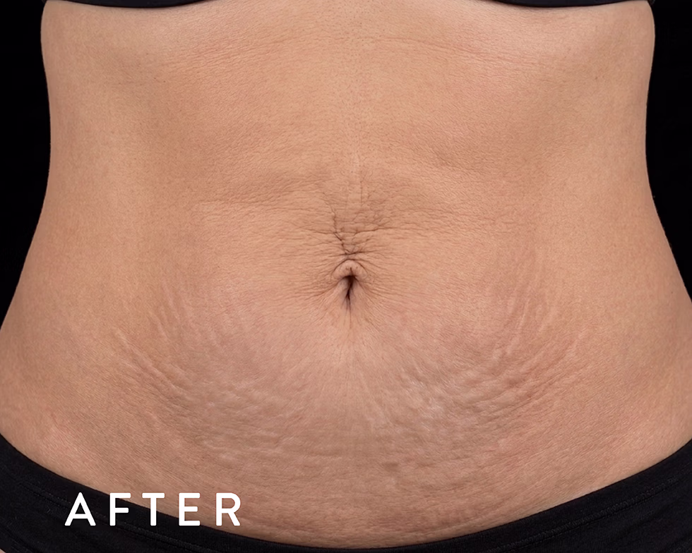 Balmori Center - Servicios - TONIFICAR BICEPS, TRICEPS Y GLÚTEOS - emsculpt neo - Radiofrecuencia + HIFEM/ Energía electromagnética focalizada de Alta Intensidad