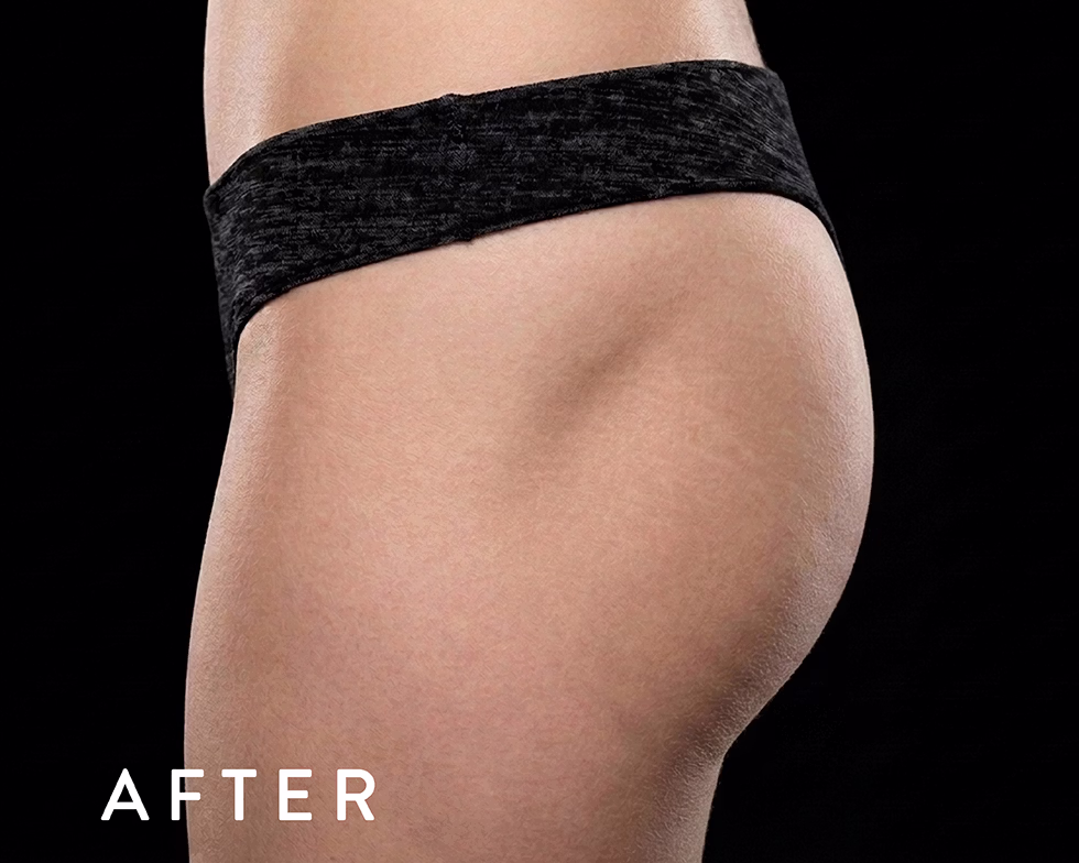 Balmori Center - Servicios - TONIFICAR BICEPS, TRICEPS Y GLÚTEOS - emsculpt neo - Radiofrecuencia + HIFEM/ Energía electromagnética focalizada de Alta Intensidad
