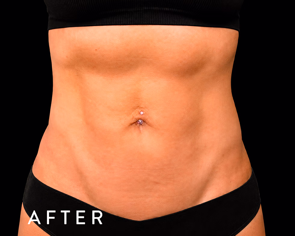 Balmori Center - MARCAR ABDOMEN, EMSCULPT NEO