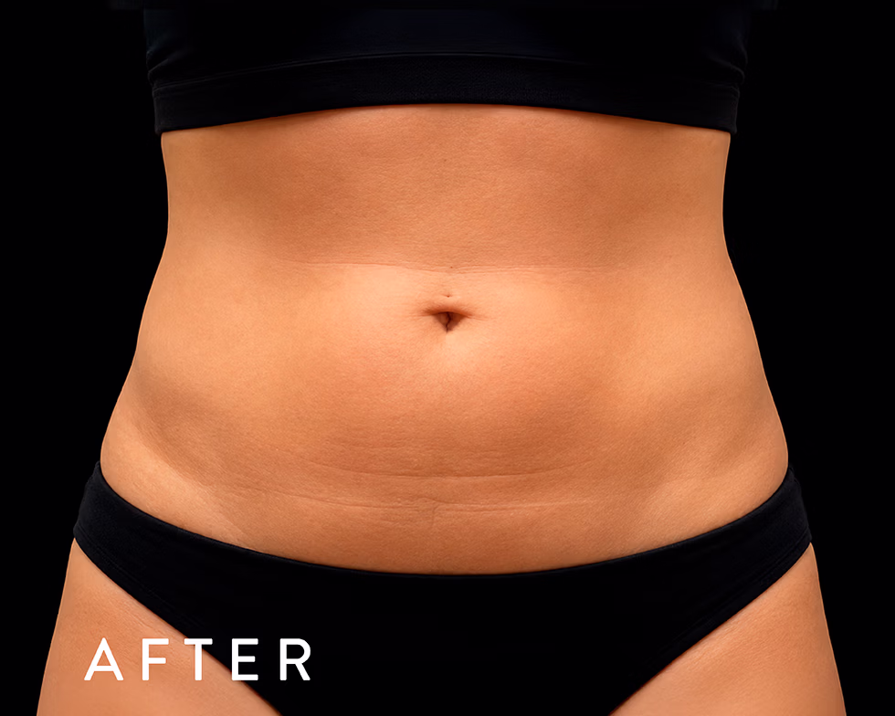 Balmori Center - MARCAR ABDOMEN, EMSCULPT NEO