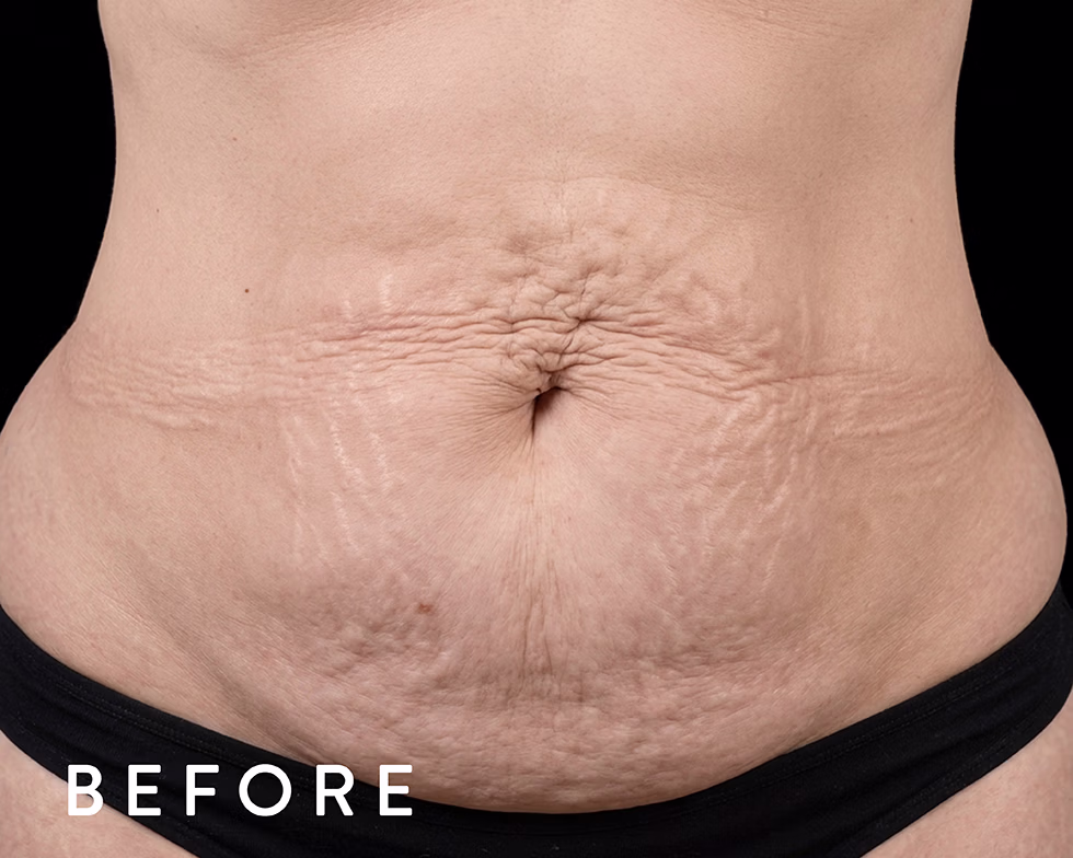 Balmori Center - Servicios - TONIFICAR BICEPS, TRICEPS Y GLÚTEOS - emsculpt neo - Radiofrecuencia + HIFEM/ Energía electromagnética focalizada de Alta Intensidad
