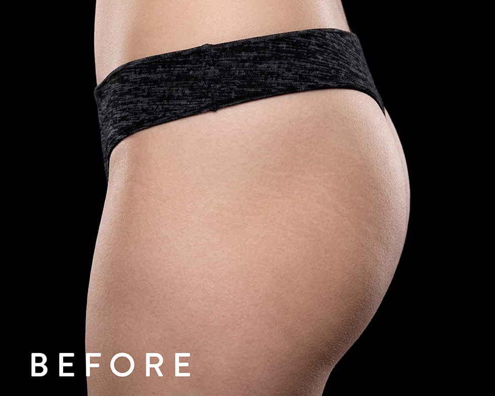 Balmori Center - Servicios - TONIFICAR BICEPS, TRICEPS Y GLÚTEOS - emsculpt neo - Radiofrecuencia + HIFEM/ Energía electromagnética focalizada de Alta Intensidad