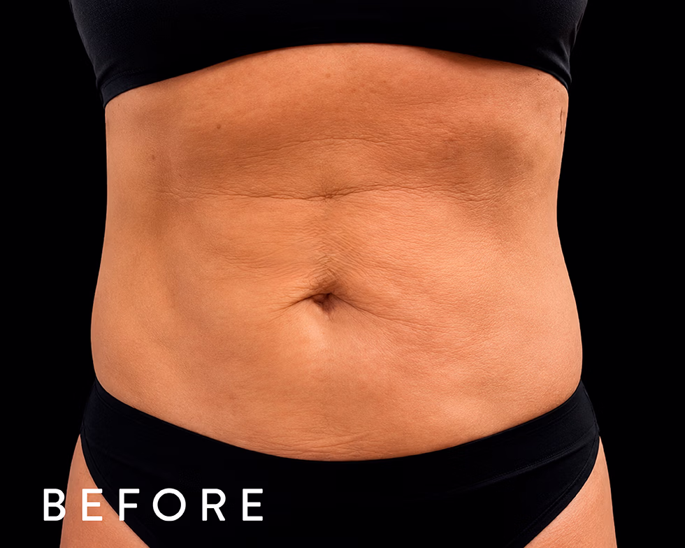 Balmori Center - MARCAR ABDOMEN, EMSCULPT NEO