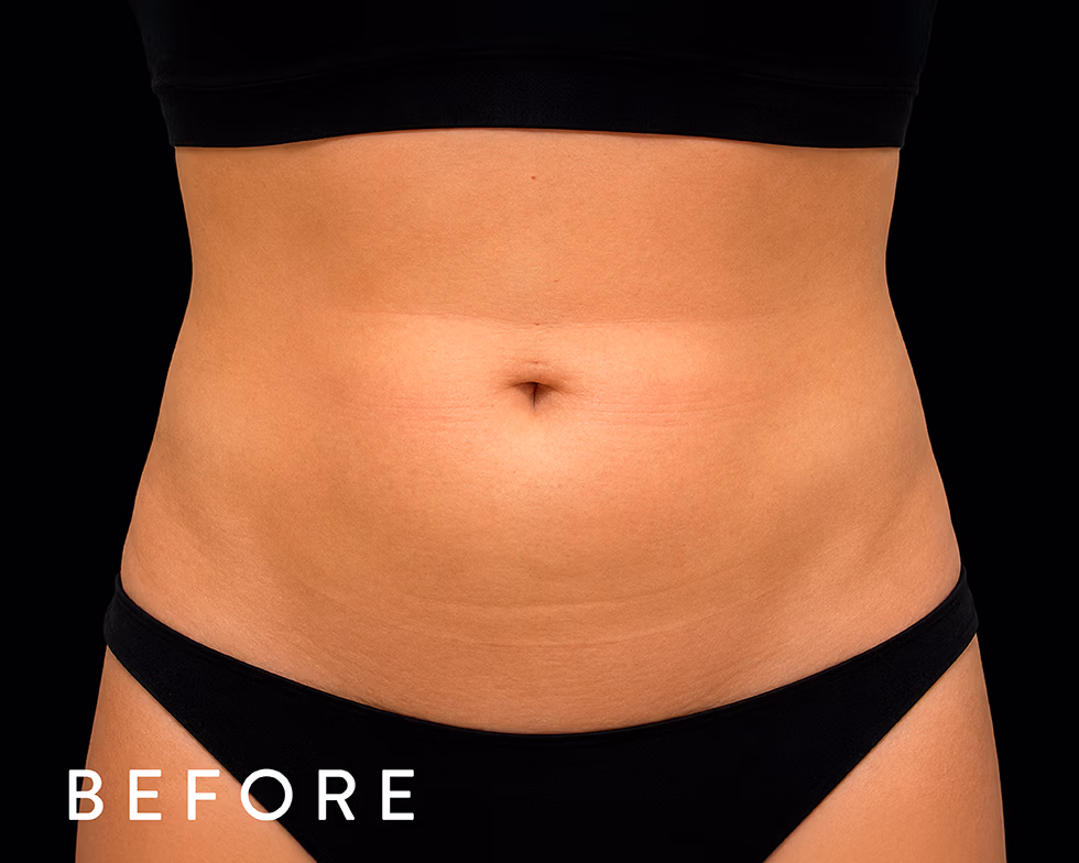 Balmori Center - MARCAR ABDOMEN, EMSCULPT NEO