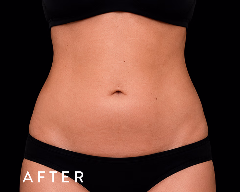 Balmori Center - REDUCIR CELULITIS Y FLACIDEZ BRAZOS, PIERNAS, GLÚTEOS Y ABDOMEN -Radiofrecuencia