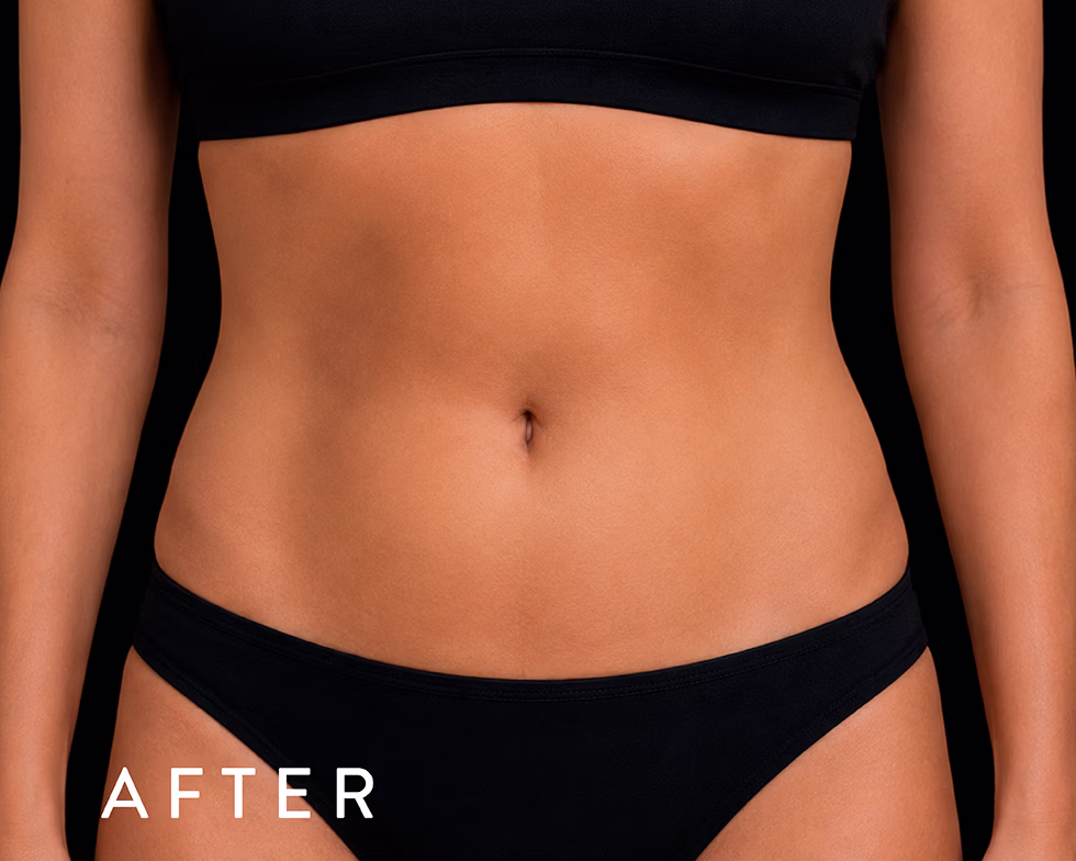 Balmori Center - REDUCIR CELULITIS Y FLACIDEZ BRAZOS, PIERNAS, GLÚTEOS Y ABDOMEN -Radiofrecuencia